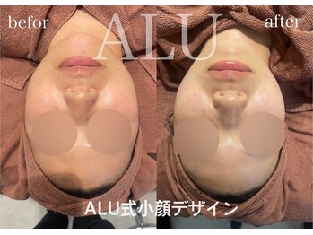 アルフォービューティー 恵比寿店(ALU for beauty)/HIRF LIFT +症例