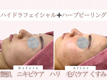 Cスキンケアクリニック 麻布店/ハイドラ+ハーブピーリング