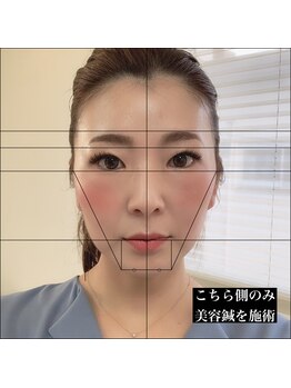ナチュライズ(NatuRise)/美容鍼の効果を半顔で実験
