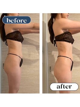 オーロラ(Aurora)/痩身ダイエットコースの２回目