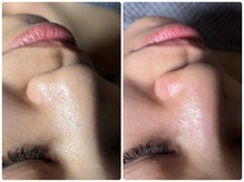 コニワ(528hz)/毛穴&フェイシャルBefore⇔After