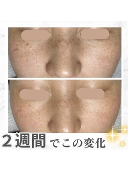 アトリア(ATRIA)/プラズマシミケア