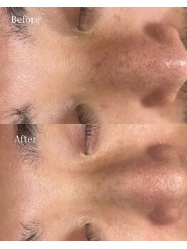 ベリスユイット(BELLIS HUIT)/【毛穴吸引】