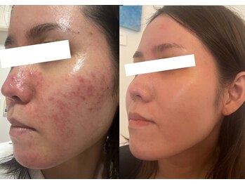 ルポ 那覇(repos)/肌トラブル特化美容鍼(100分)