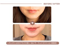 イエス マイサロン(yes My Salon)/レモンボトル施術例