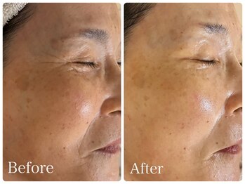 ロイヤル(ROYAL)/たるみ/シワ改善症例