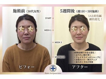 井原鍼灸整骨院/IAB美容鍼