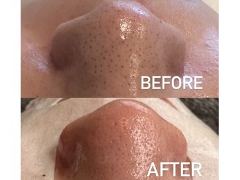 サロン チアリス(salon chiariss)の写真/速攻性を求めるあなたへ!チアリス式ハイドロ毛穴洗浄で憧れの透明感肌体験!◎