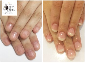 トイロ(toiro)/大切な日の為にも指先を諦めない