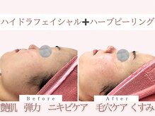 Cスキンケアクリニック 麻布店/ハイドラ＋ハーブピーリング