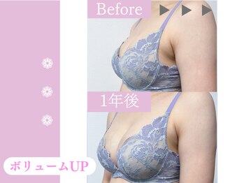 キアナ 横浜店(Kiana)/バストアップBefore After