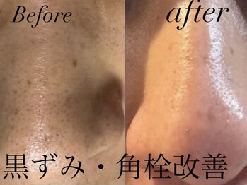 オーパーツ(OOPARTS)/ハーブピーリング/エステ