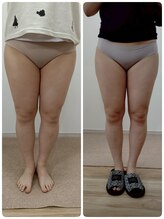 縁(en)/太もも脂肪冷却3回