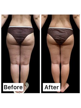 クールヴィラ(Cool Villa)/もも2×3回&痩身マッサージ3回