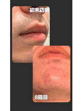 トゥルー(true)/ヒゲ脱毛　経過写真