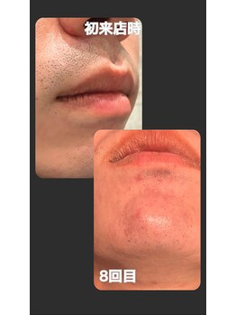 トゥルー(true)/ヒゲ脱毛　経過写真