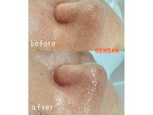 洗顔サロン 池袋(SENGAN)/溜まった毛穴汚れも残さずに洗浄