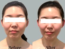 ジェイオー(J.O)/小顔矯正コルギ/リンパコルギ