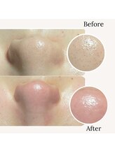 撫子アカデミー/ハイドラ＋鼻ダーマ