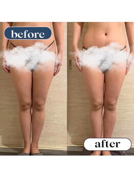 オーロラ(Aurora)/痩身ダイエットコースの1回目