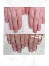 ティアラネイル 宇都宮/深爪矯正