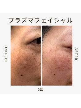 エステサロン 美飾り イオンモール木更津店/before⇒after/プラズマ