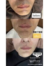 エレーヴ(Eleve)/顔脱毛経過