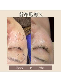 ギンザ リボーン(Ginza Reborn)の写真/40代からのシミしわ改善!幹細胞導入で自然と若々しく輝く肌へ◎