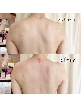 ココフルール(Cocofleur)/インディバ&アロマのセット