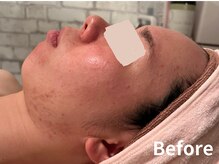 ダイヤモンド リーエンダ(Diamond leende)/クレイハーブピーリング