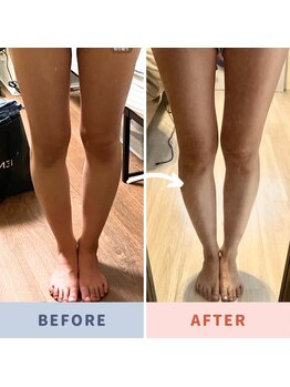 ジップス(Gyp3S=)/O脚改善だって出来ます！