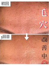 アリュール(ALLURE)/光ハイドロピーリングの施術効果