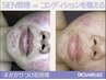 ゆらぎ肌レスキューSEN管理｜赤み・乾燥・皮脂荒れ集中ケア