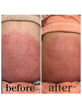 ドリームローズ(Dream Rose)/背中ニキビケア