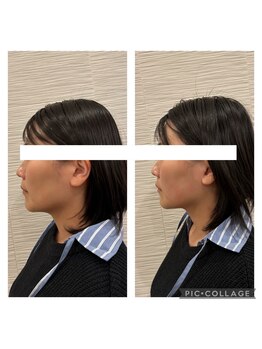 長寿鍼灸院 長寿整骨院/美容鍼50本の効果★小顔効果