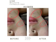 サロンエイトミー 西船橋店(salon 83)/毛穴ケア/before→after 1回施術