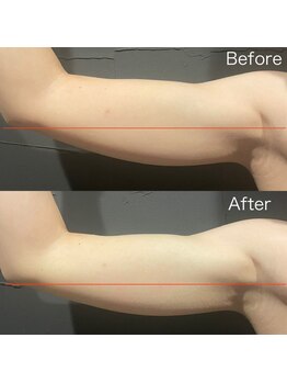 ビトタン 倉敷本店(+美to鍛)/レモンボトル（一回）