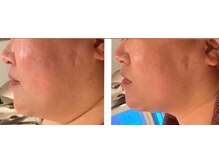 リボーテ(Re-Beaute)/レモンボトル☆最新小顔メニュー