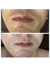 白美/美肌ヒゲ脱毛／光フェイシャル