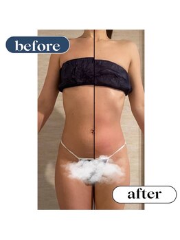 オーロラ(Aurora)/痩身ダイエットコースの1回目