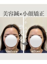 リノ ショウナン(LINO SHONAN)/美容鍼×小顔矯正