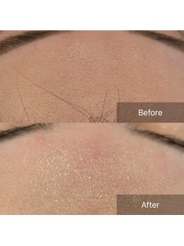 アート 熊本並木坂店(ART)/CSP/美白プラズマワックス/90分