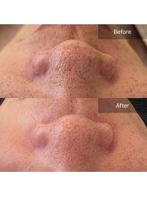 リアン(Lien)/長岡天神/毛穴洗浄/ララピール