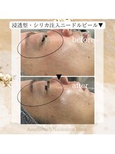 ビヌ(Binu)/浸透型・シリカ注入ピール