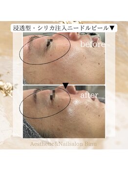 ビヌ(Binu)/浸透型・シリカ注入ピール