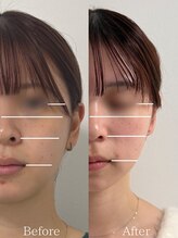 ひじ鍼灸整骨院/小顔鍼Before /After◎