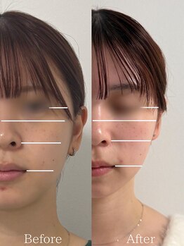 ひじ鍼灸整骨院/小顔鍼Before /After◎