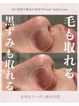 レア(Lea)/毛も取れる!!毛穴洗浄＊