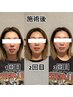 【30日以内の再来】小顔美顔矯正