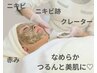 【ニキビにお悩みの方へ】剥離なし!REL'ABEAUTEハーブピーリング×ヒト幹細胞